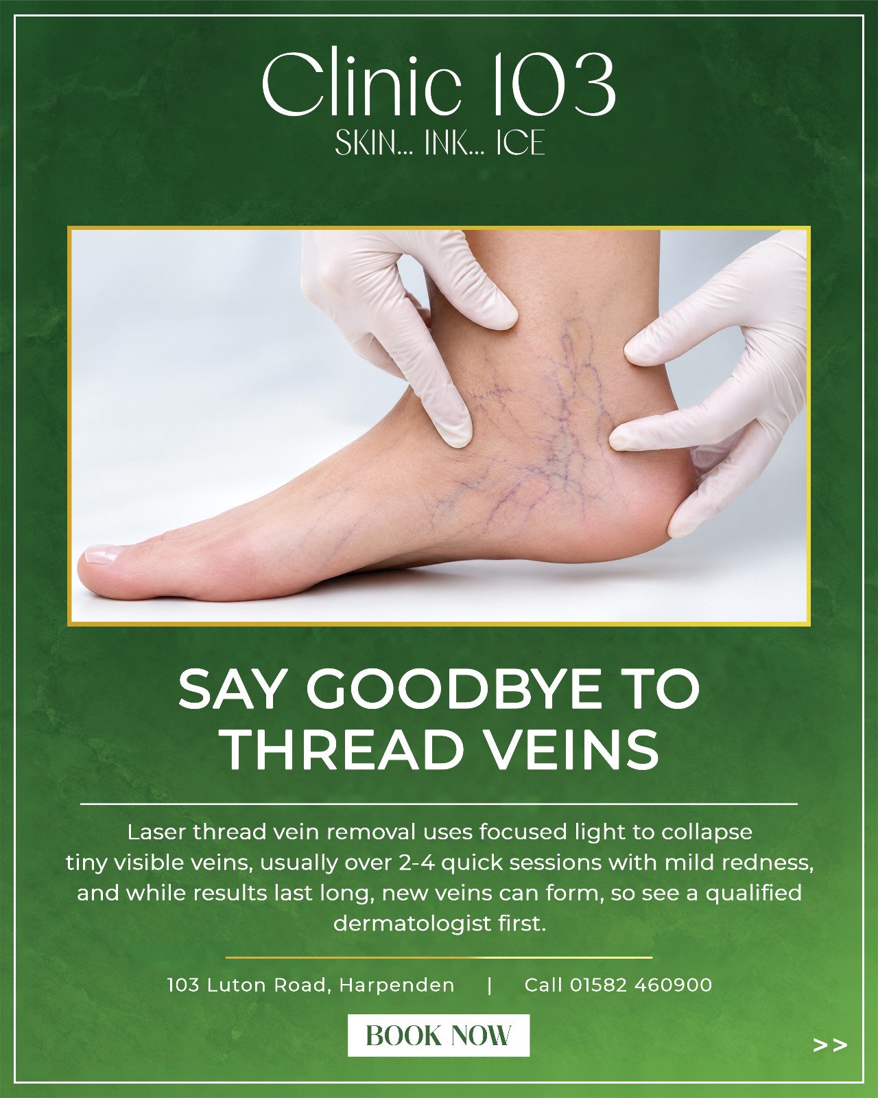 Laser thread vein removal treatment at Clinic 103 Harpenden — Say goodbye to thread veins